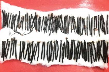 111 nails taken out of patient stomach in Thrissur