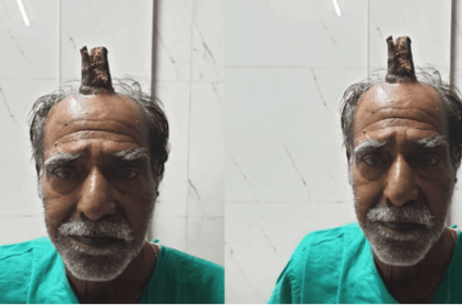 74 year old man grows devil\'s horn on head after injury