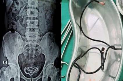 A person inserted mobile charger through the urinary tract