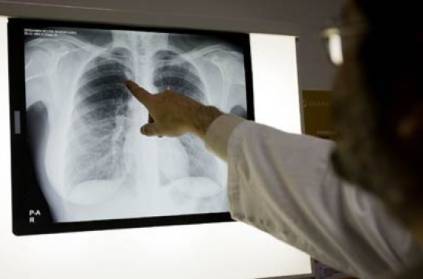 Doctors remove tip of pen from man’s lung after 18 years in Kerala
