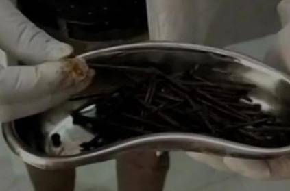 doctors removes 116 iron nails, pellets, wires from rajasthan patient