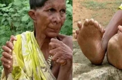 old woman born with 20 toe, 12 fingers, believes witch