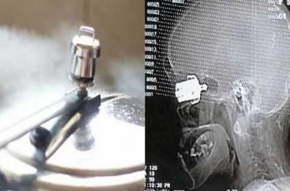 Woman blinded after cooker whistle exploded into her skull