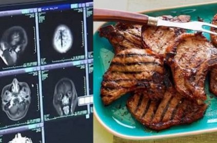 700 Tapeworms Found in Man\'s Brain, Chest and Lungs After Eating Pork
