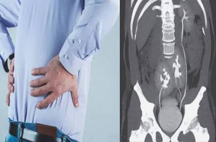 38 year old Brazilian man with back pain finds out he has 3 kidneys