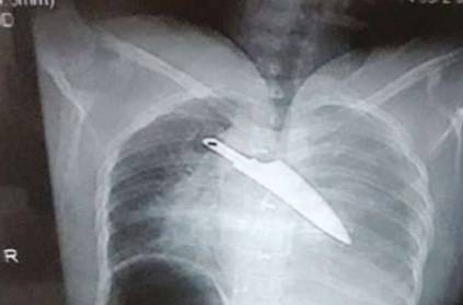 Coimbatore Doctors Remove 7 Cm Knife From women\'s Chest