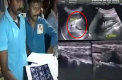 Hospital left cloth in womans stomach during operation in Hosur