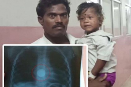 Madurai 2 year old boy swallowed remote battery
