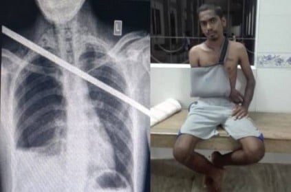 Madurai government doctors removed rod from mans chest