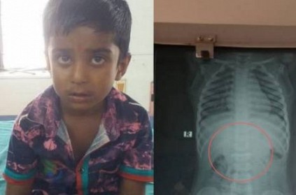 the 5 year old boy swallowed the iron nail near hosur