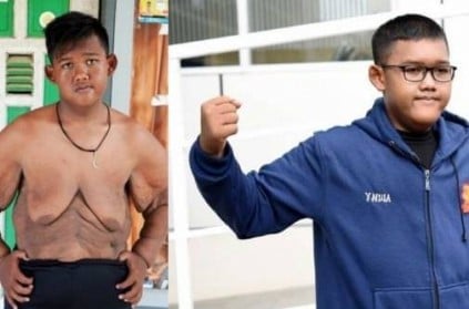 Arya Permana : World\'s fattest boy who weighed 190 KG shows off