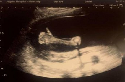 Baby in womb gives mom thumbs up during ultrasound