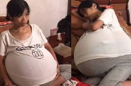 china woman belly grows uncontrollably weighs 19 kgs medical condition