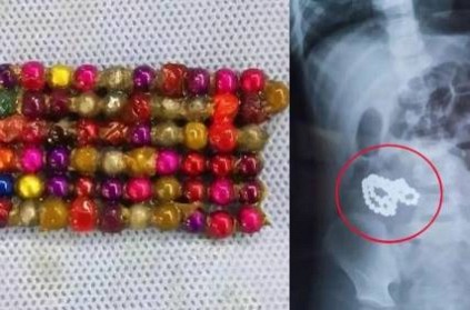 Doctors find popular kids toy in six year old’s stomach