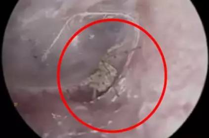 Doctors find spider building a nest inside a man’s ear