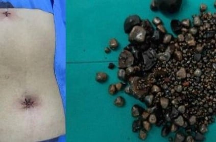Doctors Remove Nearly 2000 Gallstones From Woman Stomach In Thailand
