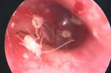 Man had family of cockroaches living inside his ear