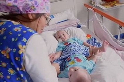 mother told Christmas miracle as conjoined twins separated
