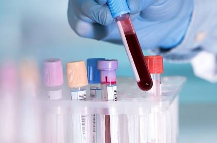 People with blood type A may be more vulnerable to Coronavirus