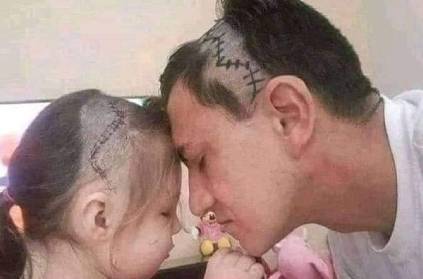 dad shaves head to look a like his daughter head after her surgery