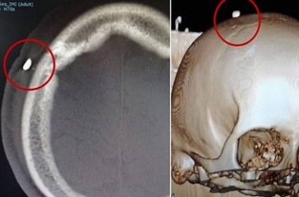 Tooth removed from 14 year old boy skull after he was bitten